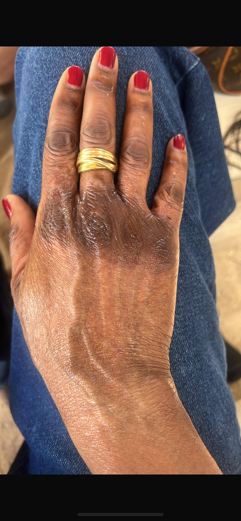 Avant — Hyperpigmentation du dos de la main