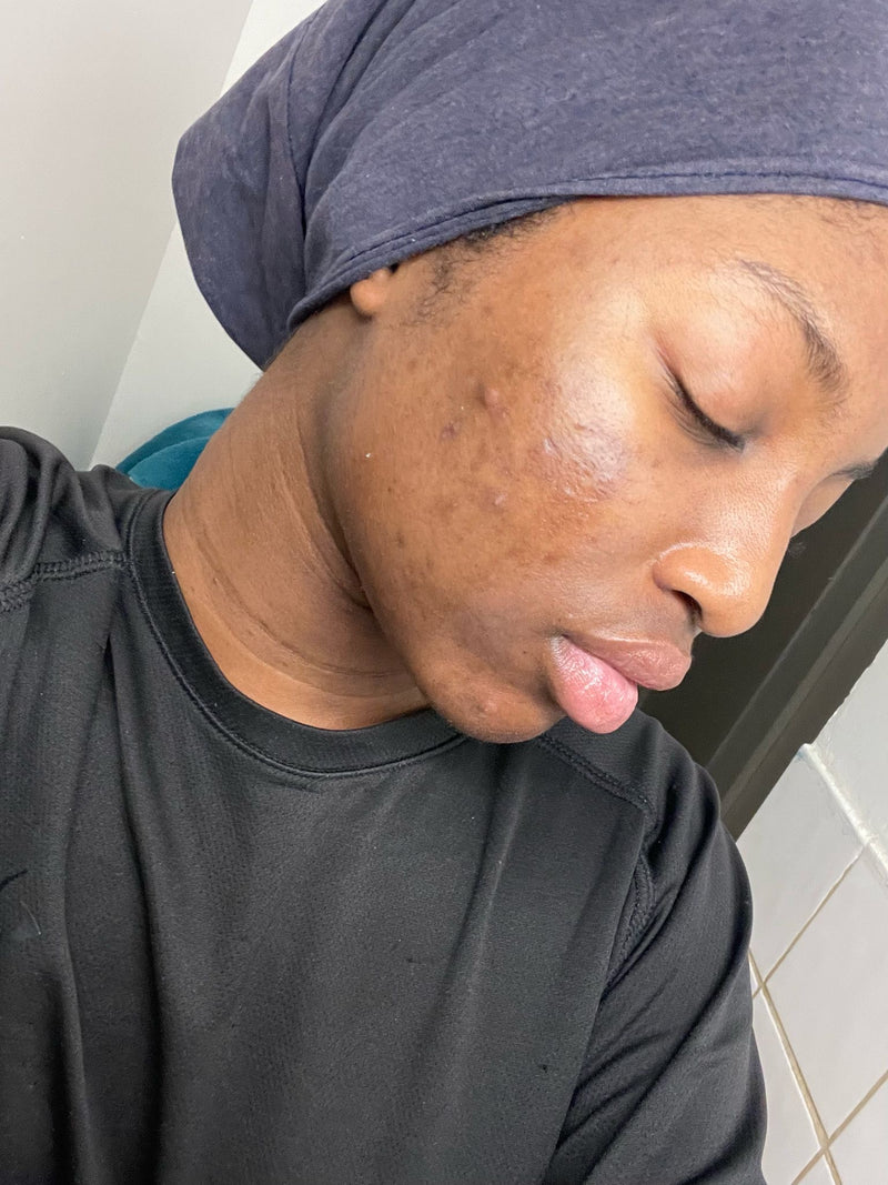 Avant — Acné inflammatoire et taches