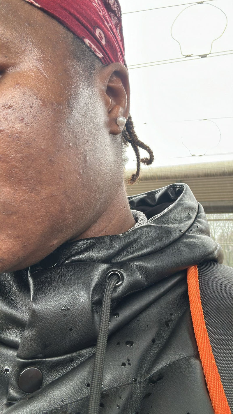 Après — Boutons en relief, peau apaisée