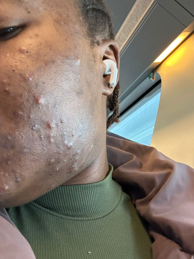 Avant — Boutons en relief, peau apaisée